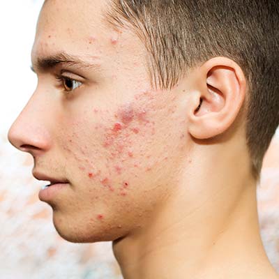 Acne and acne scar treatment dermatologist consultation