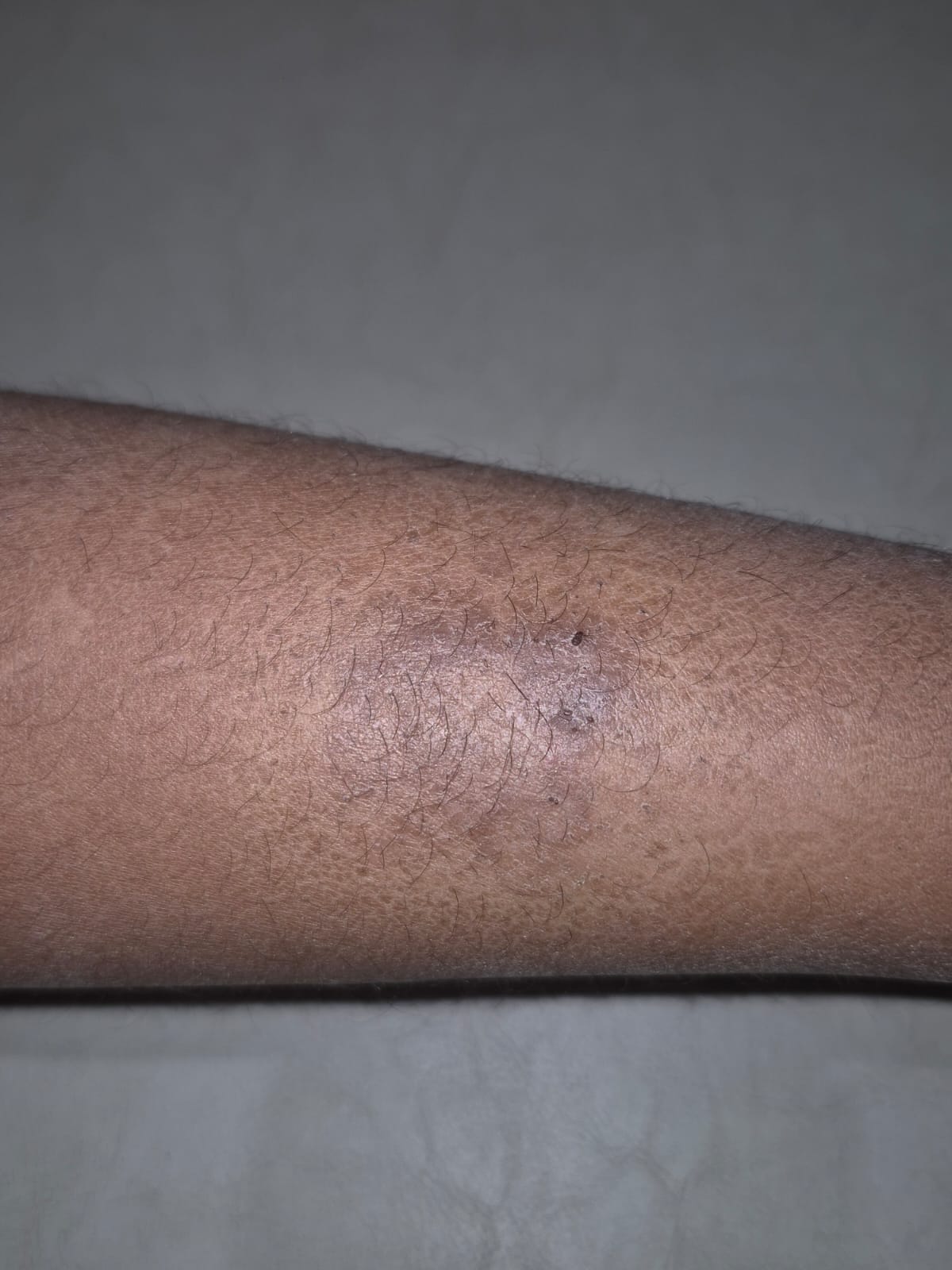 त्वचेवर नाण्यासारखे गोल चट्टे आलेत? कारण फंगल इन्फेक्शनच असेल असे नाही!