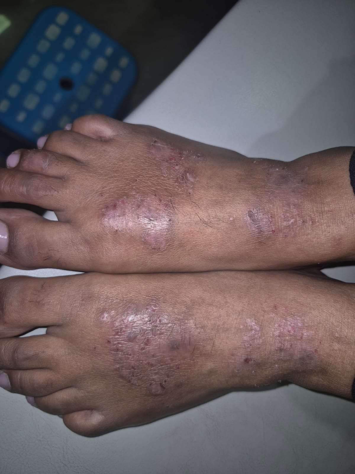 world eczema day